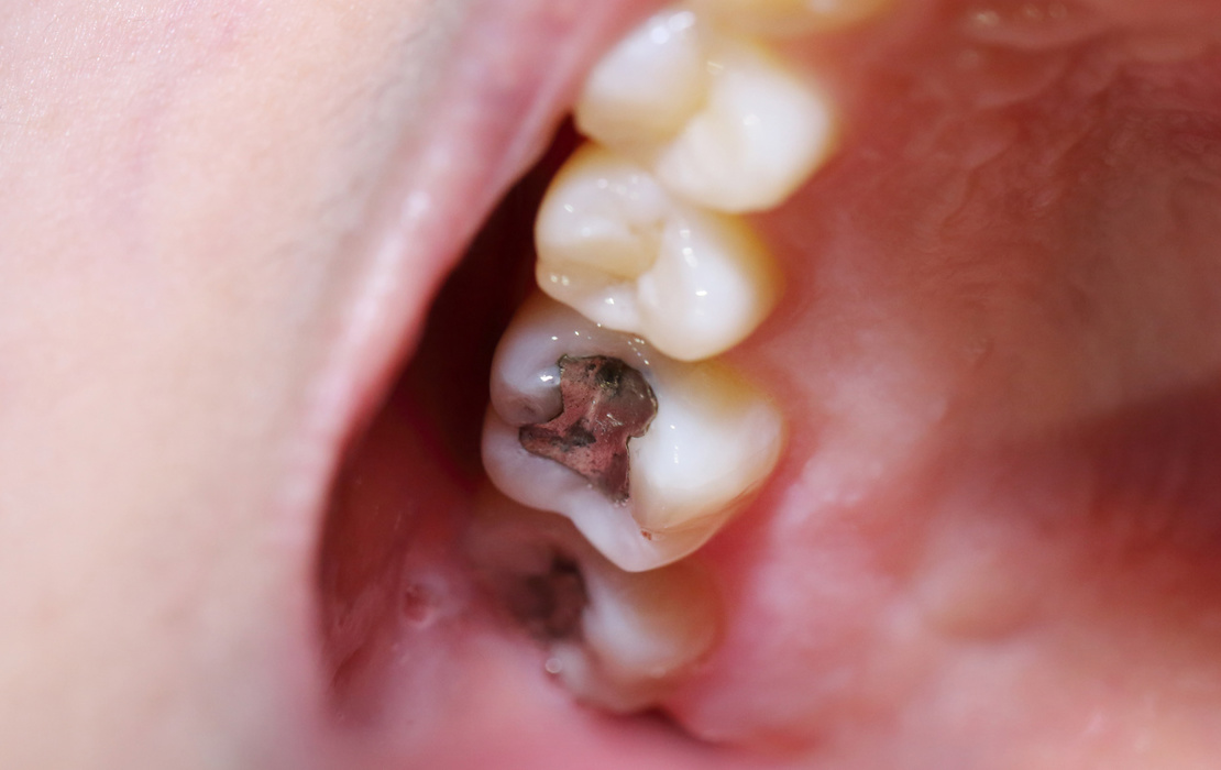 Indian Health Service to end dental amalgam use by 2027